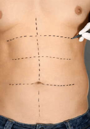 Tummy Tuck