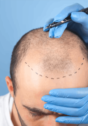 Hair Transplant