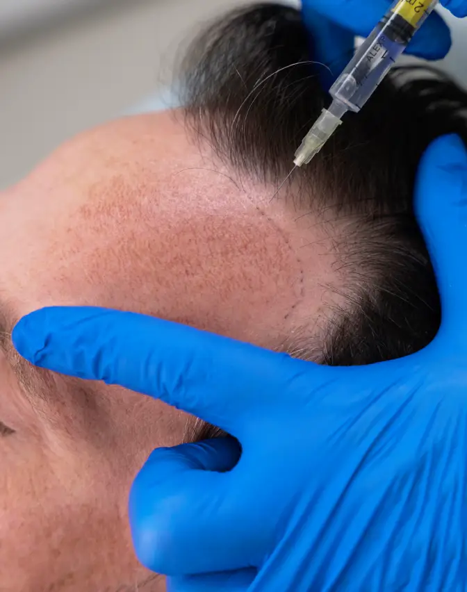 Hair transplant