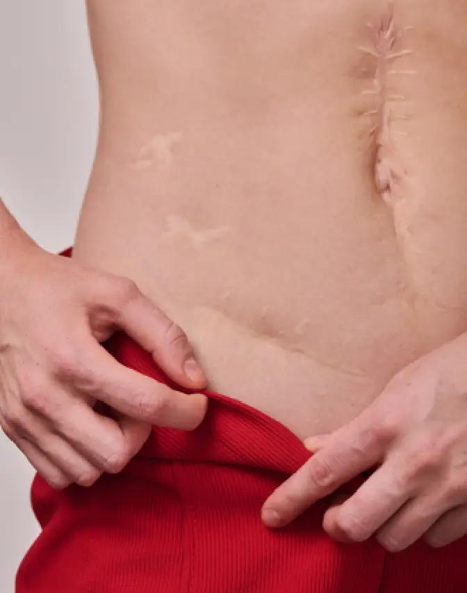 Scar surgery