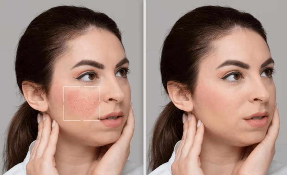 What Are the Benefits of Having a Hydra Facial?
